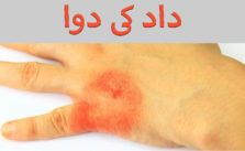 Ringworm Home Treatment In Urdu