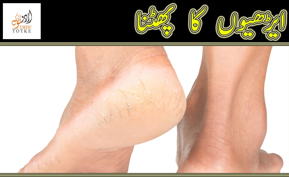 How to cure cracked heels in urdu and hindi