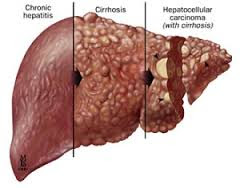 hepatitis ka rohani ilaj in urdu